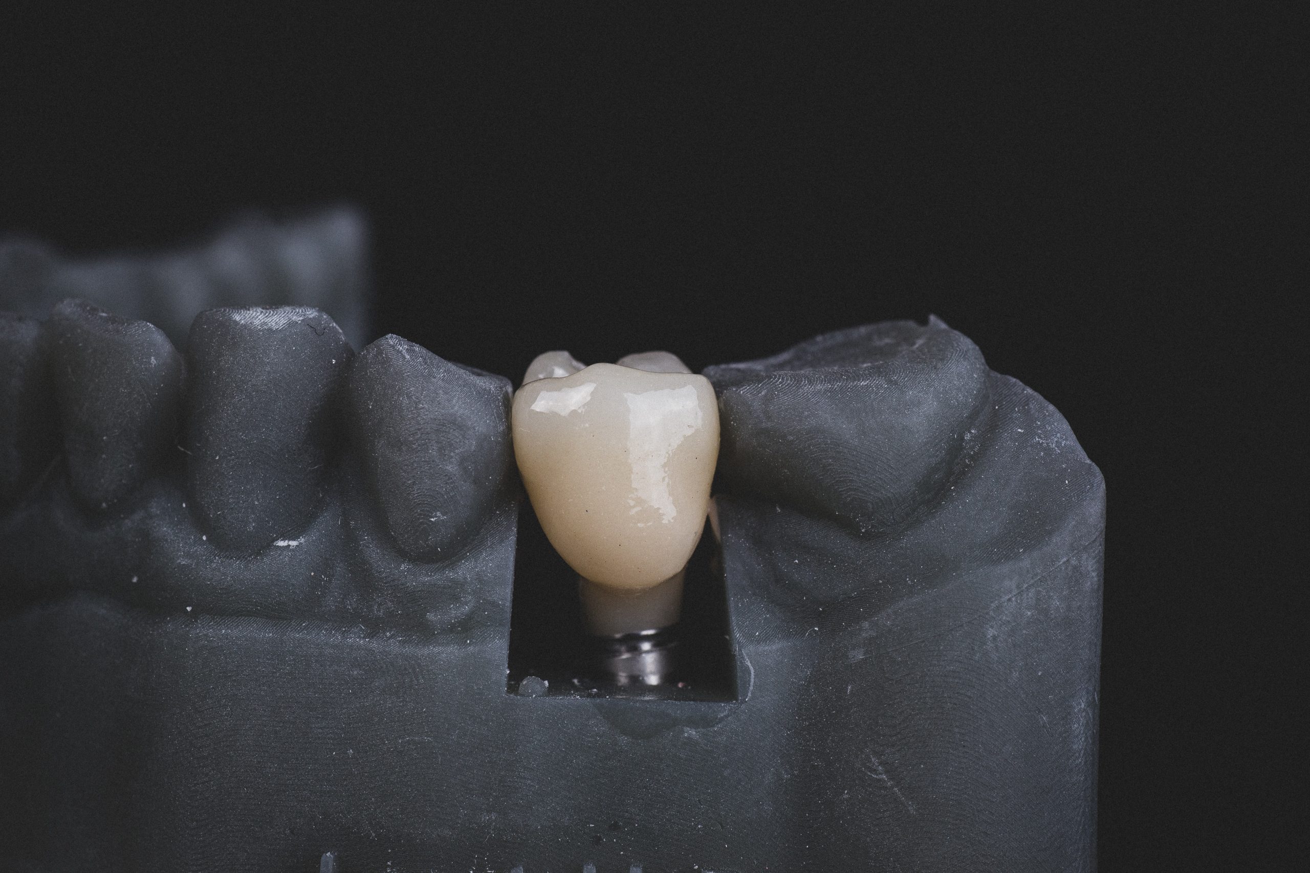The Dental Implant Process