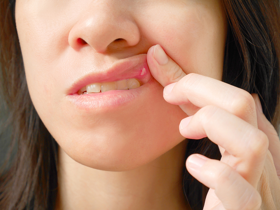 A DENTIST IN OAK HILL EXPLAINS CANKER SORES AND HOW TO REMOVE THEM
