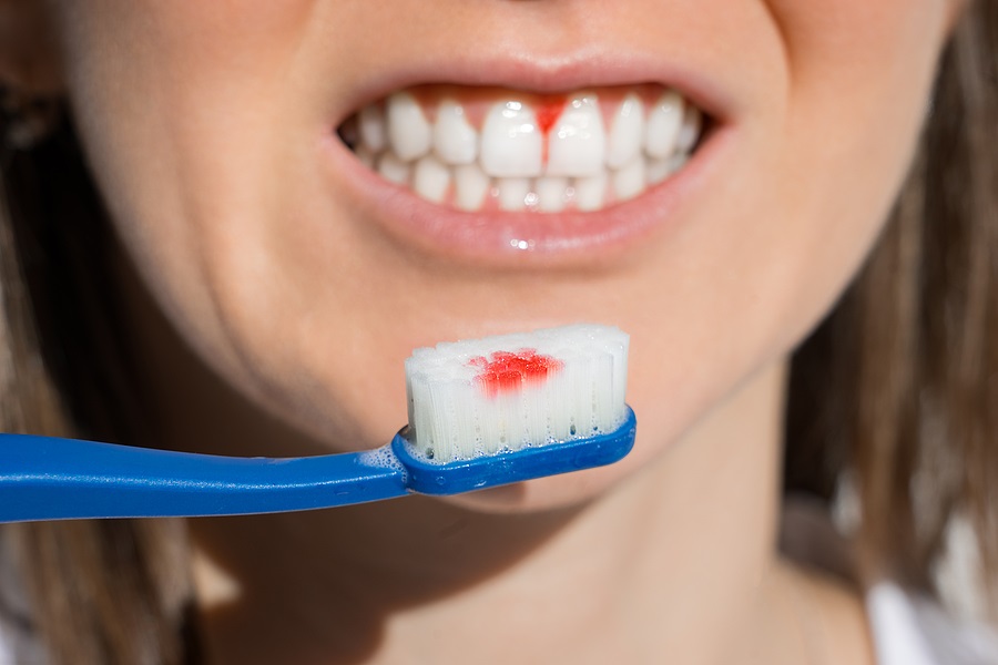 GUM DISEASE IS GENETIC, BUT HERE ARE 3 WAYS TO PREVENT IT