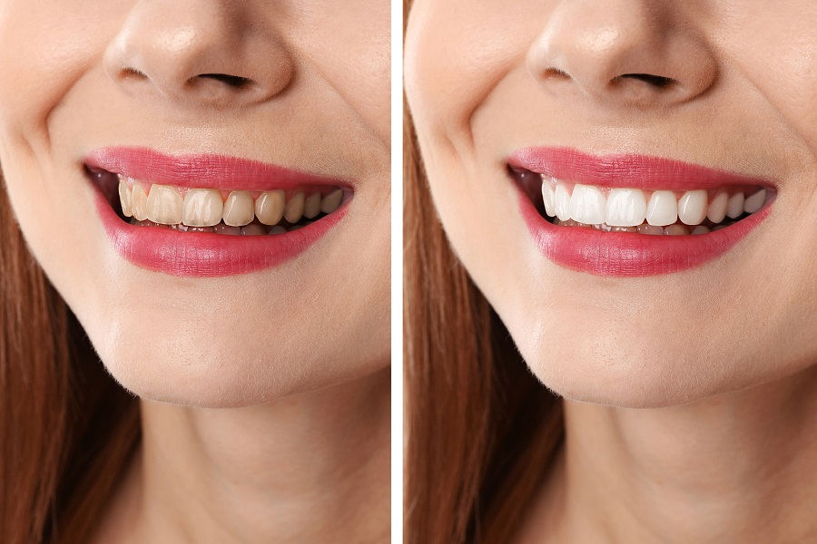 WHEN TO WHITEN TEETH BEFORE A WEDDING OR SPECIAL EVENT