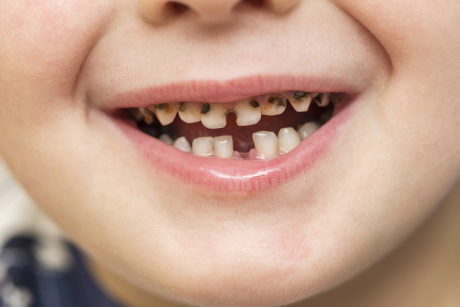 4 FACTS ABOUT CAVITIES FROM YOUR FAMILY DENTIST IN OAK HILL