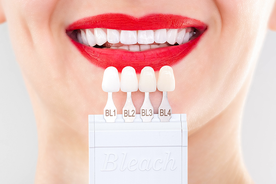 4 DIY TEETH WHITENING MISTAKES TO AVOID BY GETTING PROFESSIONAL TREATMENT